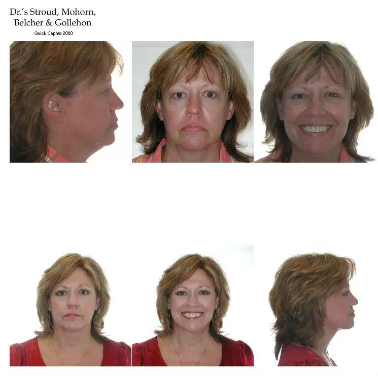 Liposuction NeckLift