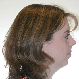 chin augmentation