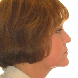 facial liposuction