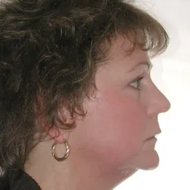 facial liposuction